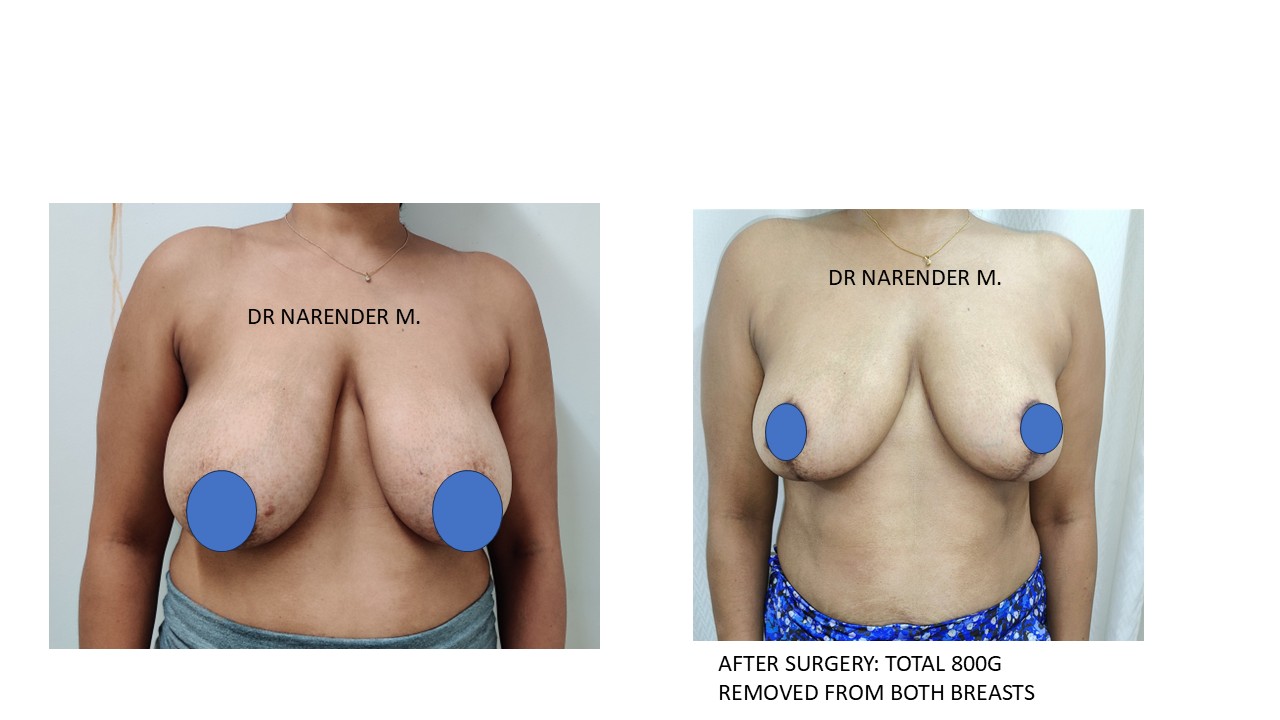 Breast Reconstruction Photo 9